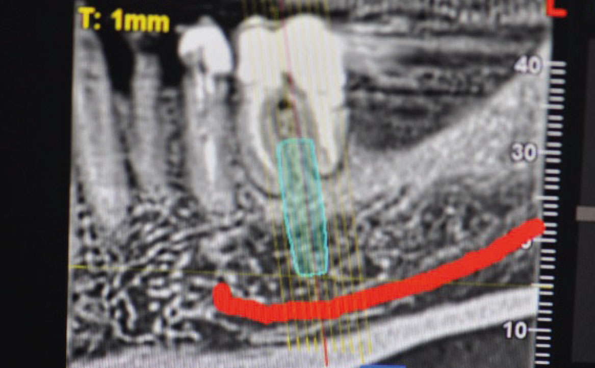 Fig. 3 ICBCT con posizionamento di un impianto virtuale e segnalazione del nervo alveolare inferiore.
