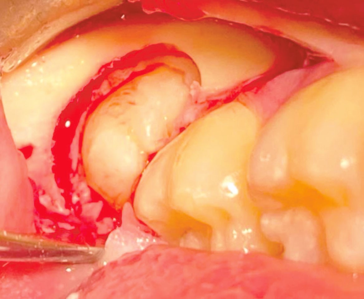 Fig. 3 Lembo e osteotomia.