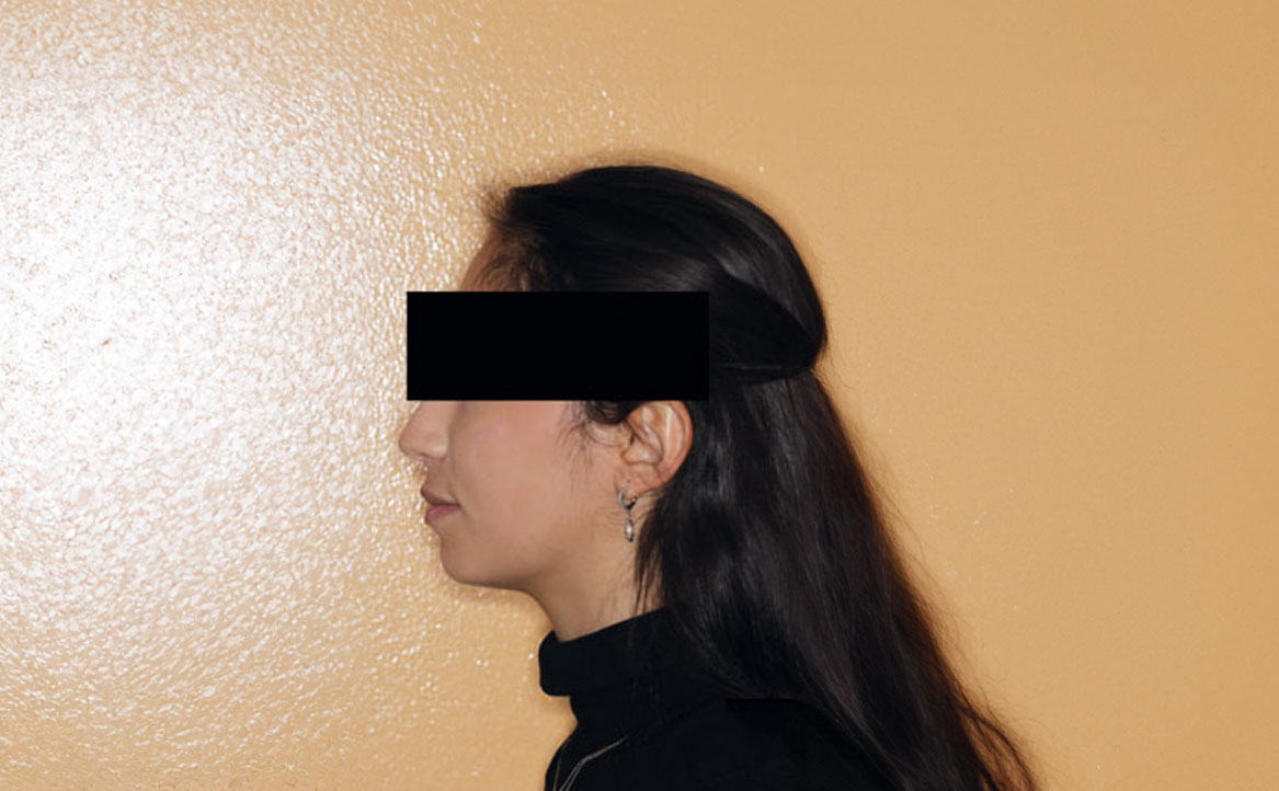 Fig. 1C Foto laterale a riposo.