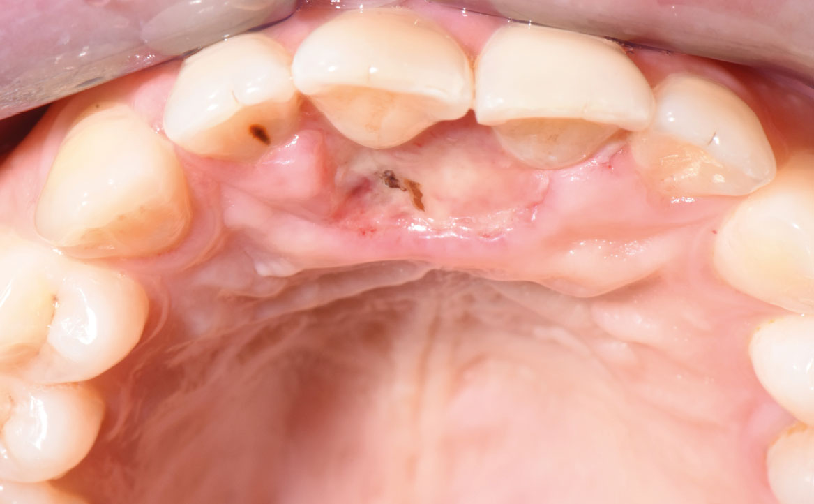 Fig. 3 Foto intra-orale dopo una settimana dall’escissione chirurgica della lesione.