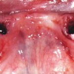 Fig. 4 Alveolo post-estrattivo.