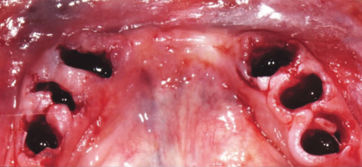 Fig. 4 Alveolo post-estrattivo.
