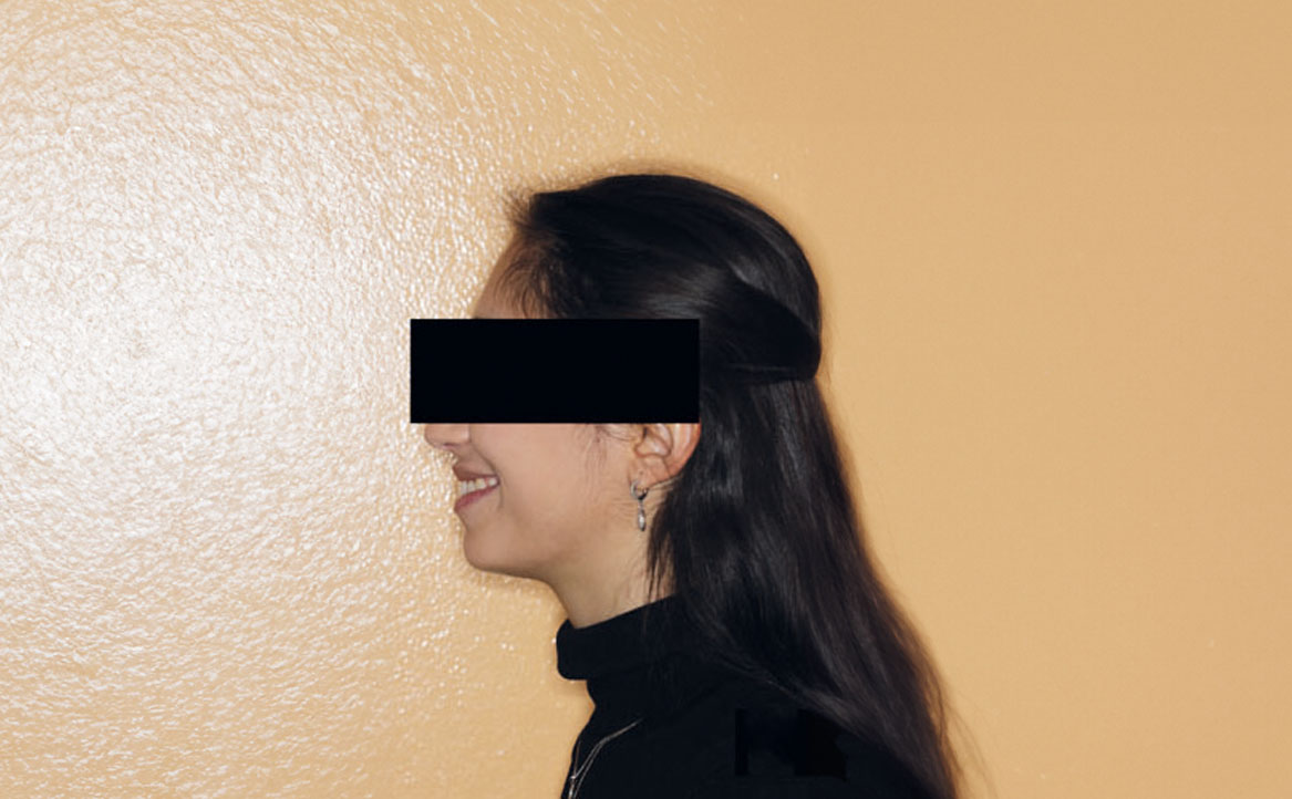 Fig. 1D Foto laterale con sorriso.