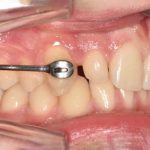 Fig. 4A Secondo check-up.