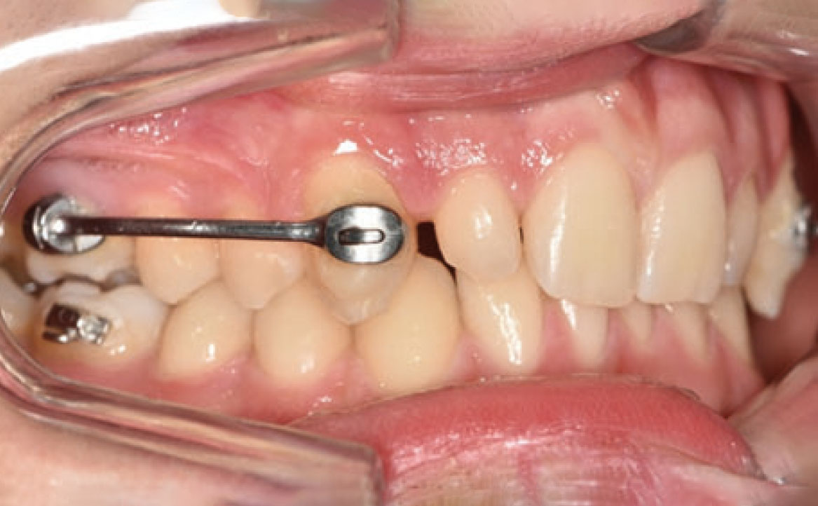 Fig. 4A Secondo check-up.