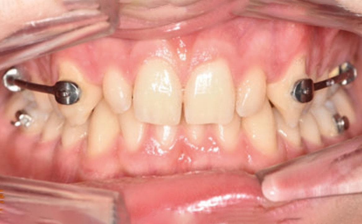 Fig. 4B Secondo check-up.