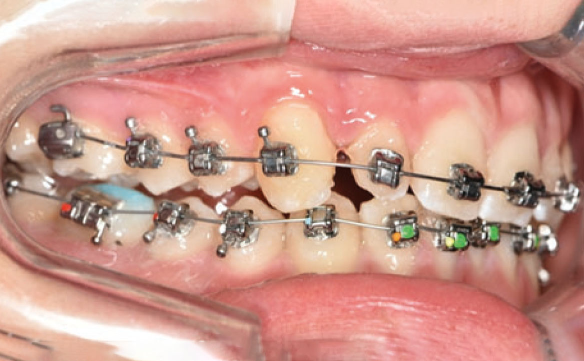 Fig. 5A Bandaggio superiore e inferiore, rialzi occlusali ed elastici di Classe II.