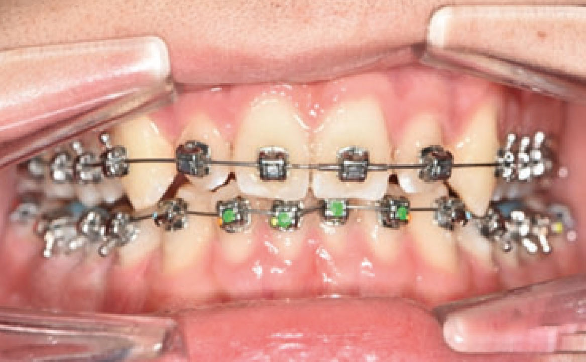 Fig. 5B Bandaggio superiore e inferiore, rialzi occlusali ed elastici di Classe II.