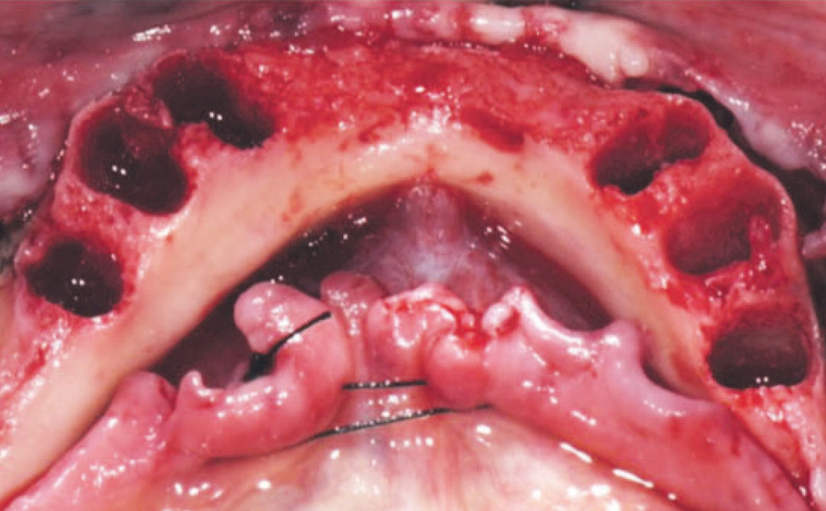 Fig. 6 Lembo vestibolare a tutto spessore.