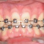 Fig. 6B Rimozione dei rialzi occlusali e riduzione del tempo di utilizzo degli elastici.