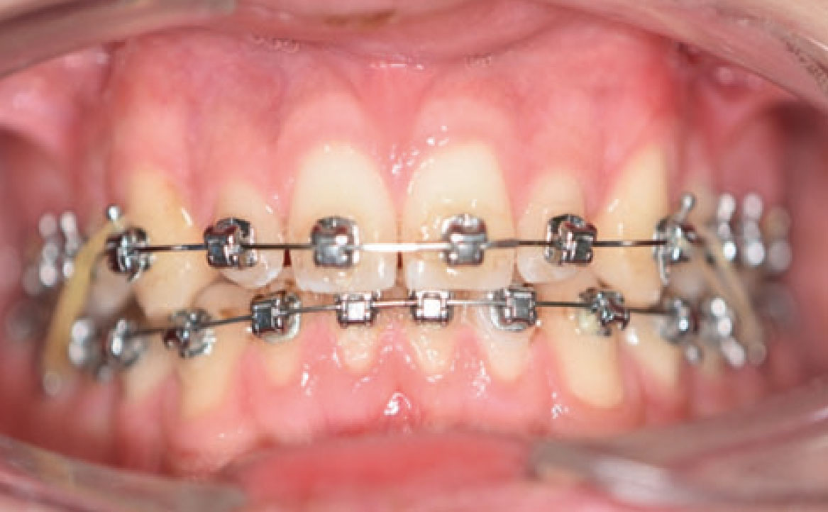 Fig. 6B Rimozione dei rialzi occlusali e riduzione del tempo di utilizzo degli elastici.
