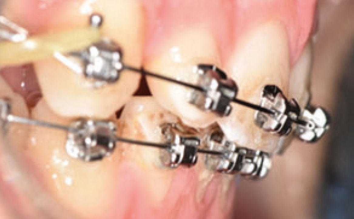 Fig. 6D Rimozione dei rialzi occlusali e riduzione del tempo di utilizzo degli elastici.