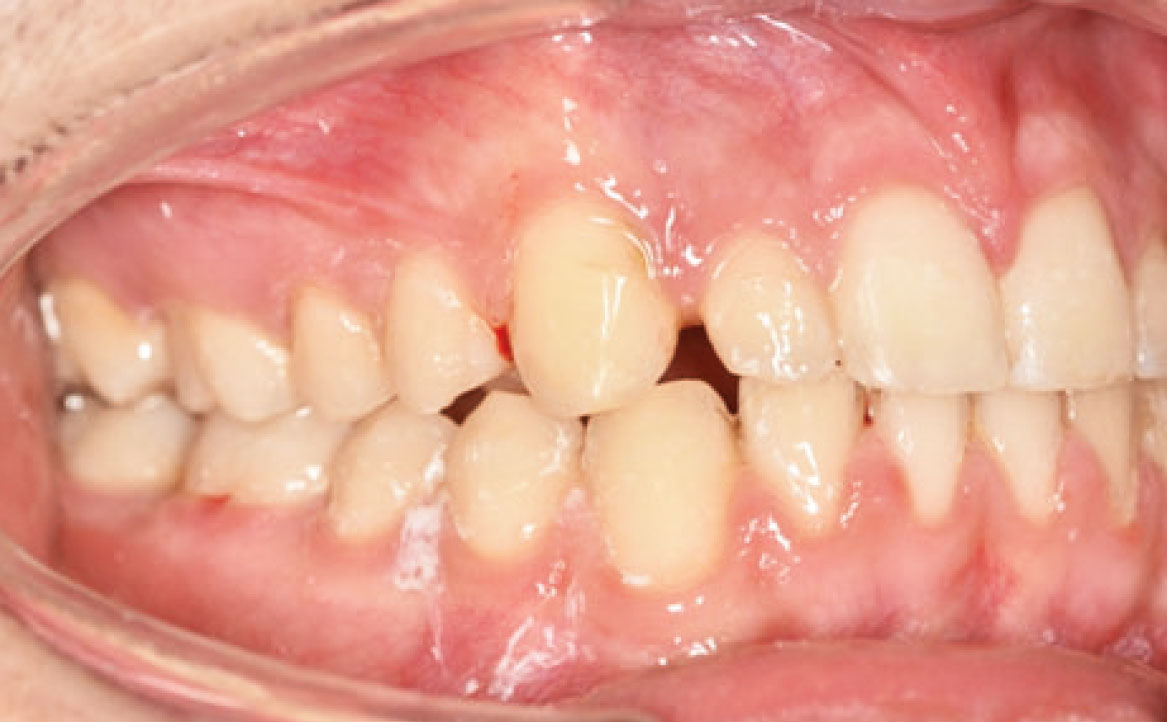 Fig. 7A Debonding di entrambe le arcate.