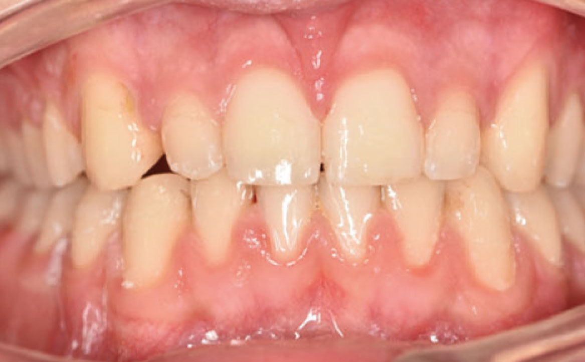 Fig. 7B Debonding di entrambe le arcate.