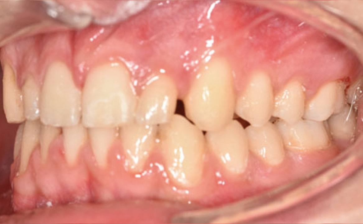 Fig. 7C Debonding di entrambe le arcate.