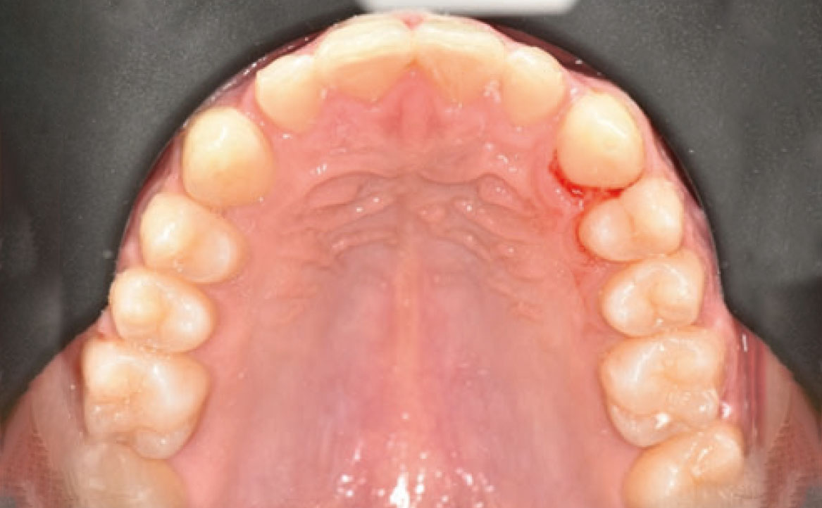 Fig. 7D Debonding di entrambe le arcate.