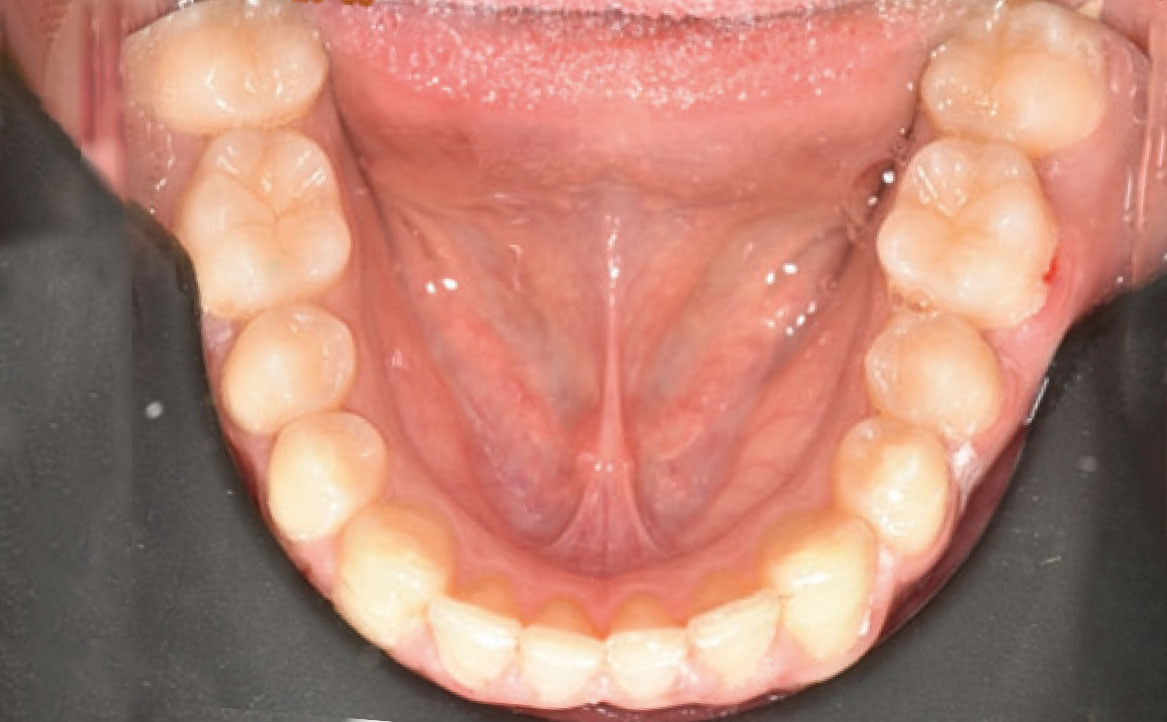 Fig. 7E Debonding di entrambe le arcate.