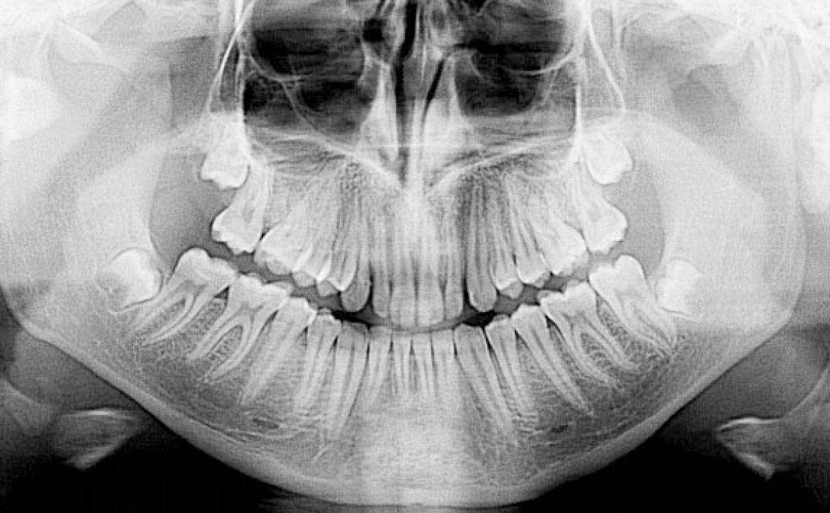 Fig. 8 OPT 12 mesi dopo la fine del trattamento.