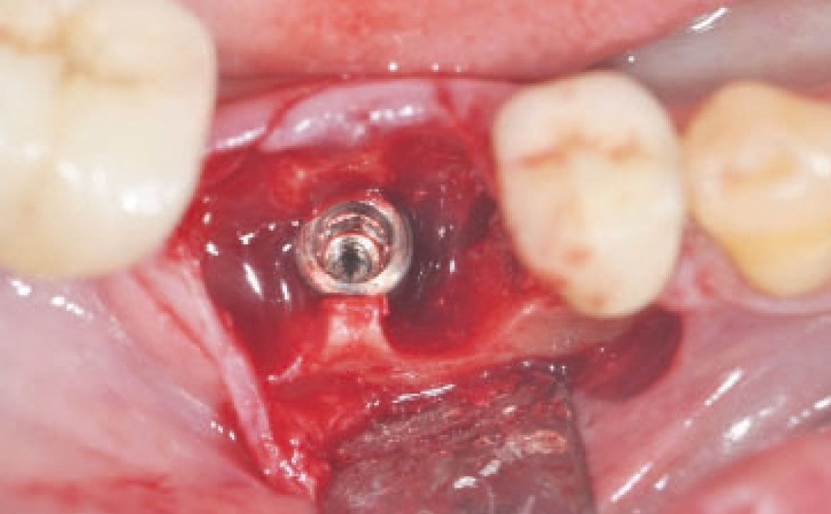 Fig. 8 Inserimento impianto.