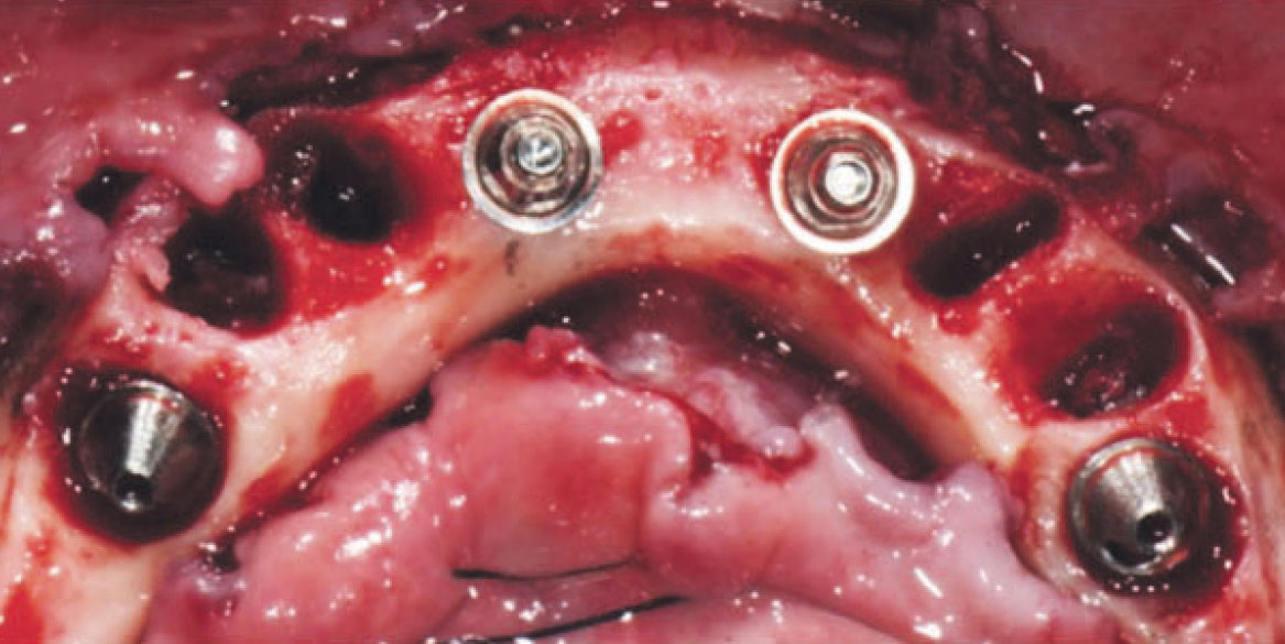 Fig. 9 Posizionamento degli abutment.