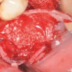 Fig. 10 Fissata membrana di pericardio lingualmente con Tissel.