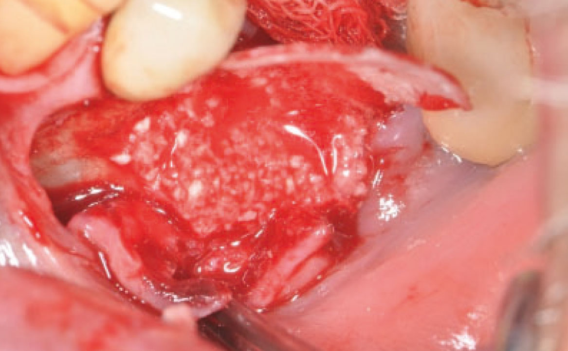 Fig. 10 Fissata membrana di pericardio lingualmente con Tissel.