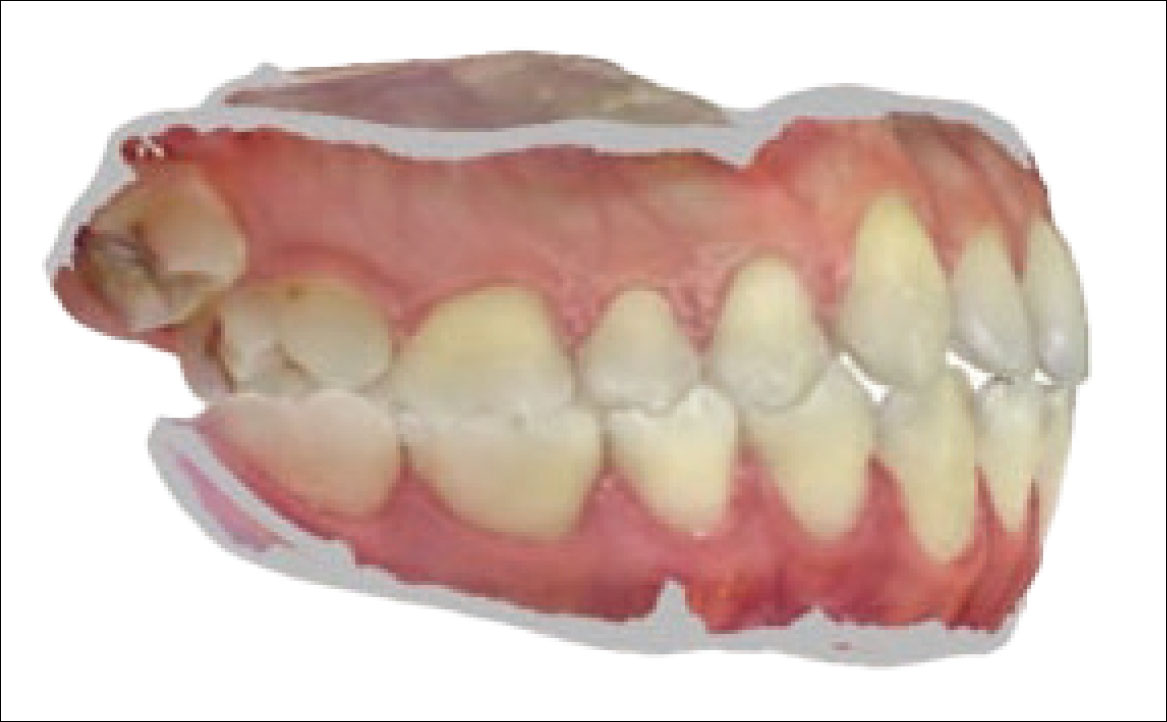 Fig. 3A Scansione intraorale: foto laterale di destra.