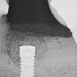 Fig. 12 Radiografia endorale con follow up a 30 giorni.