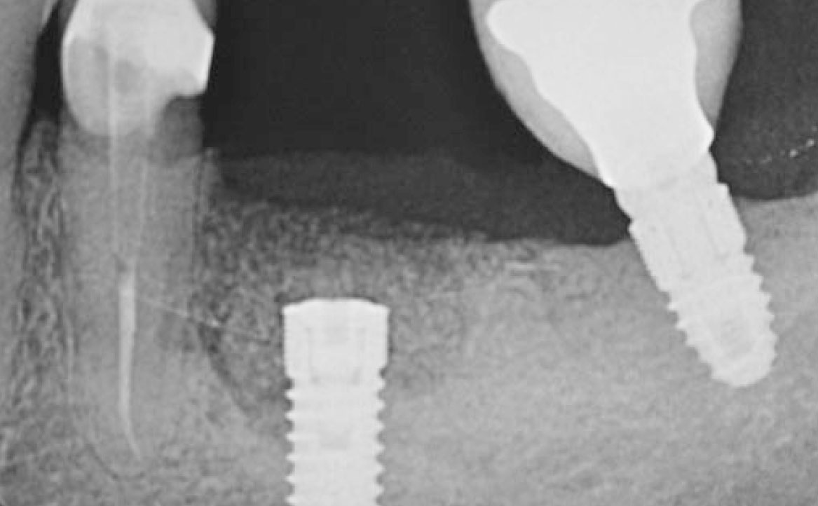 Fig. 12 Radiografia endorale con follow up a 30 giorni.