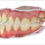 Fig. 3C Scansione intraorale: foto laterale di sinistra.