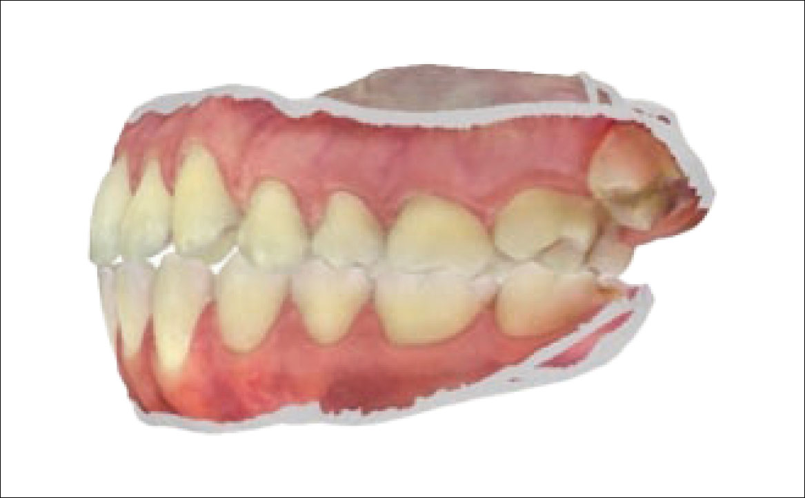 Fig. 3C Scansione intraorale: foto laterale di sinistra.