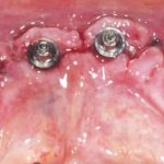 Fig. 13 Mucosa dopo la rimozione della sutura.