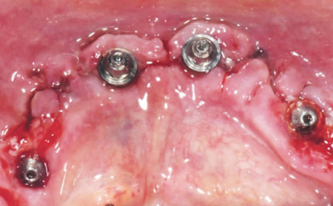 Fig. 13 Mucosa dopo la rimozione della sutura.