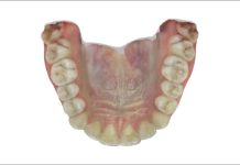 Applicazione del flusso di lavoro digitale personalizzato al riposizionamento mandibolare: un caso clinico di un paziente affetto da DTM Fig. 3E Scansione intraorale: foto arcata superiore.