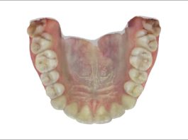 Applicazione del flusso di lavoro digitale personalizzato al riposizionamento mandibolare: un caso clinico di un paziente affetto da DTM Fig. 3E Scansione intraorale: foto arcata superiore.