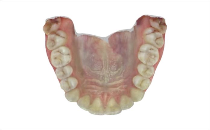 Fig. 3E Scansione intraorale: foto arcata superiore. Fig. 3E Scansione intraorale: foto arcata superiore.