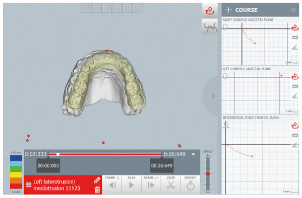Fig. 4D Registrazione cinematica mandibolare durante i movimenti di apertura.