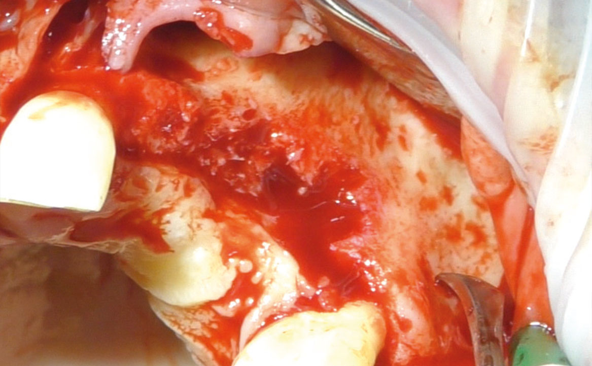 Fig. 3 Ottenimento del completo degloving e scheletrizzazione del mascellare superiore.