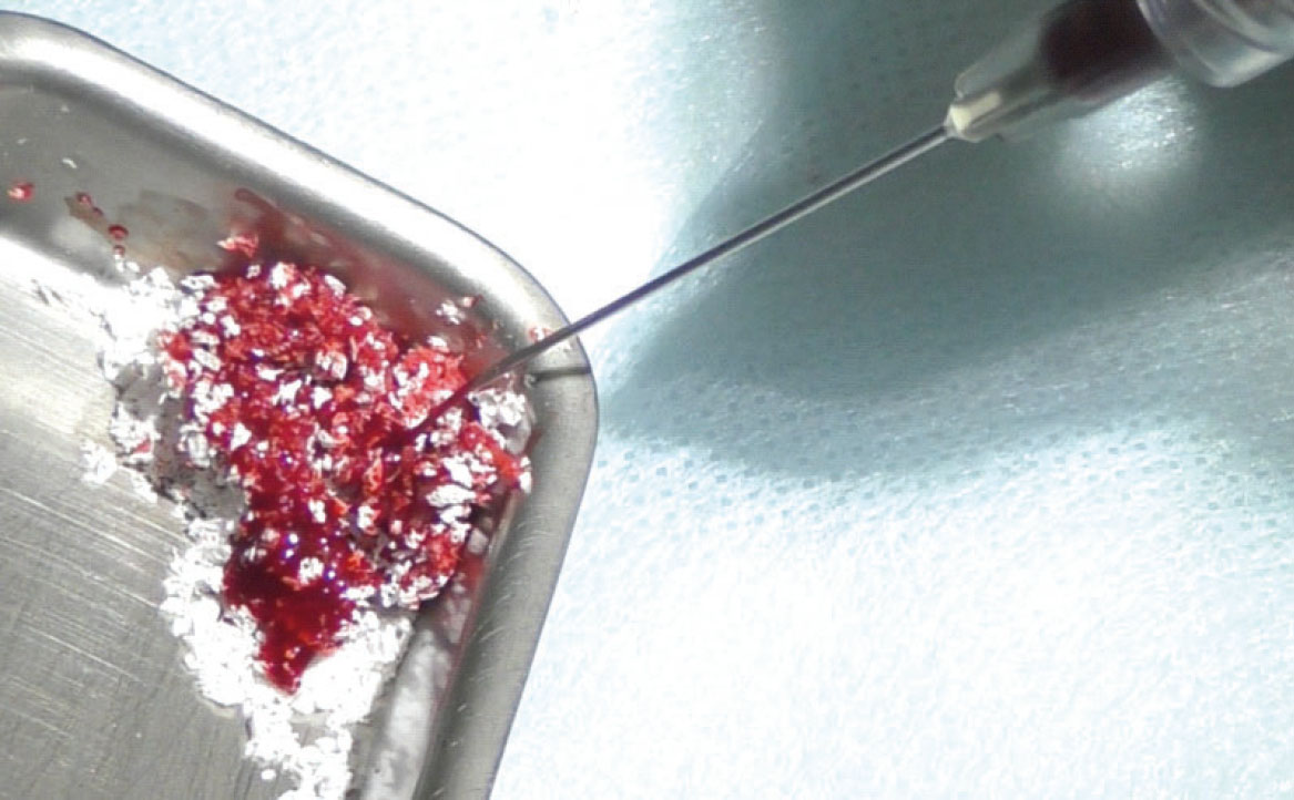 Fig. 8 Aggiunta di sangue venoso del paziente al biomateriale.