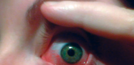 occhio secco
