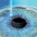 chirurgia_rifrattiva1