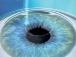 Nuove frontiere in chirurgia rifrattiva corneale: SMILE (Femtosecond Laser Lenticule Extraction) chirurgia rifrattiva