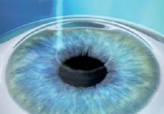 chirurgia rifrattiva