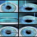 chirurgia_rifrattiva2