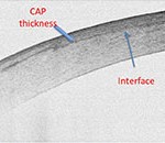 chirurgia_rifrattiva3