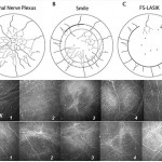 chirurgia_rifrattiva4