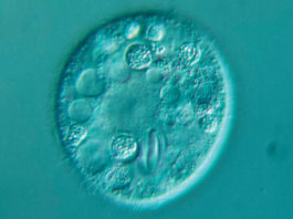 Fattori di rischio nella progressione del glaucoma primario ad angolo aperto: uno studio condotto a Torino