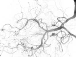 Le novità sull’angiografia OCT vengono illustrate in un Congresso Internazionale a Roma