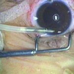 Fig. 3 Posizionamento del mantenitore di camera anteriore.