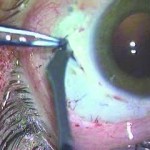 Fig. 4 Incisione degli sportelli sclerali.